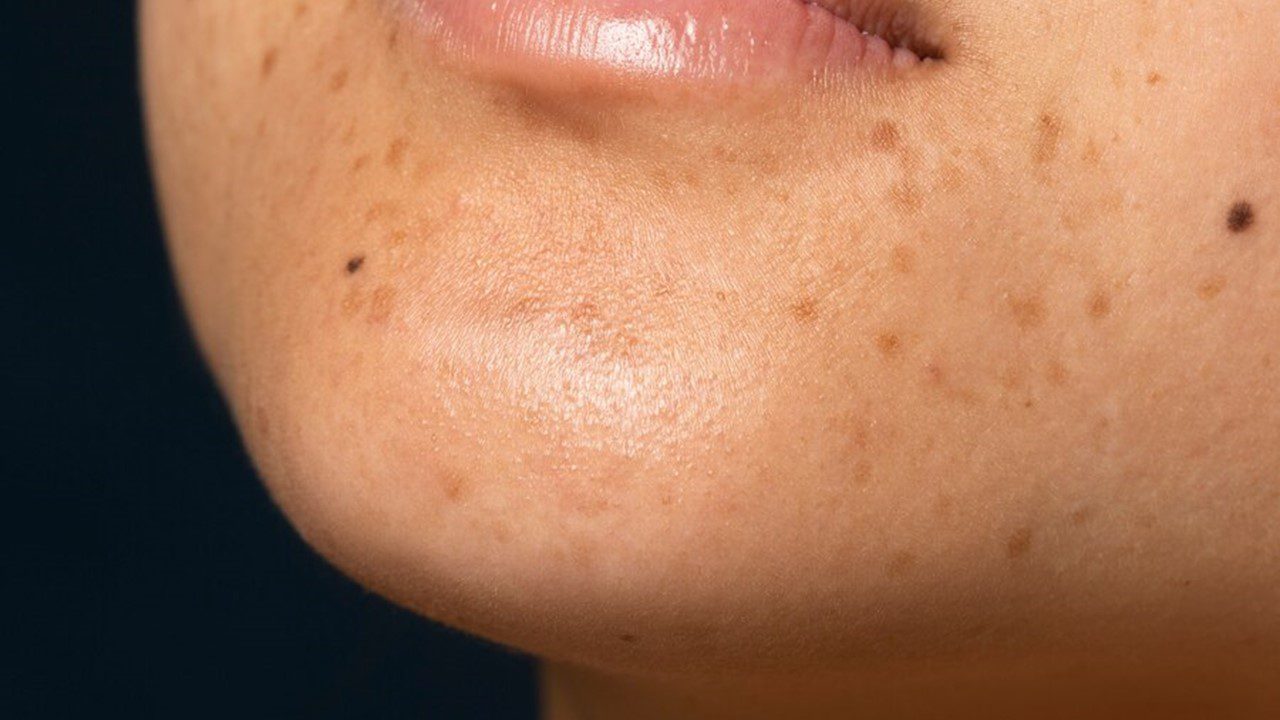 Unveiling the Secrets of Hyperpigmentation: A Comprehensive Guide